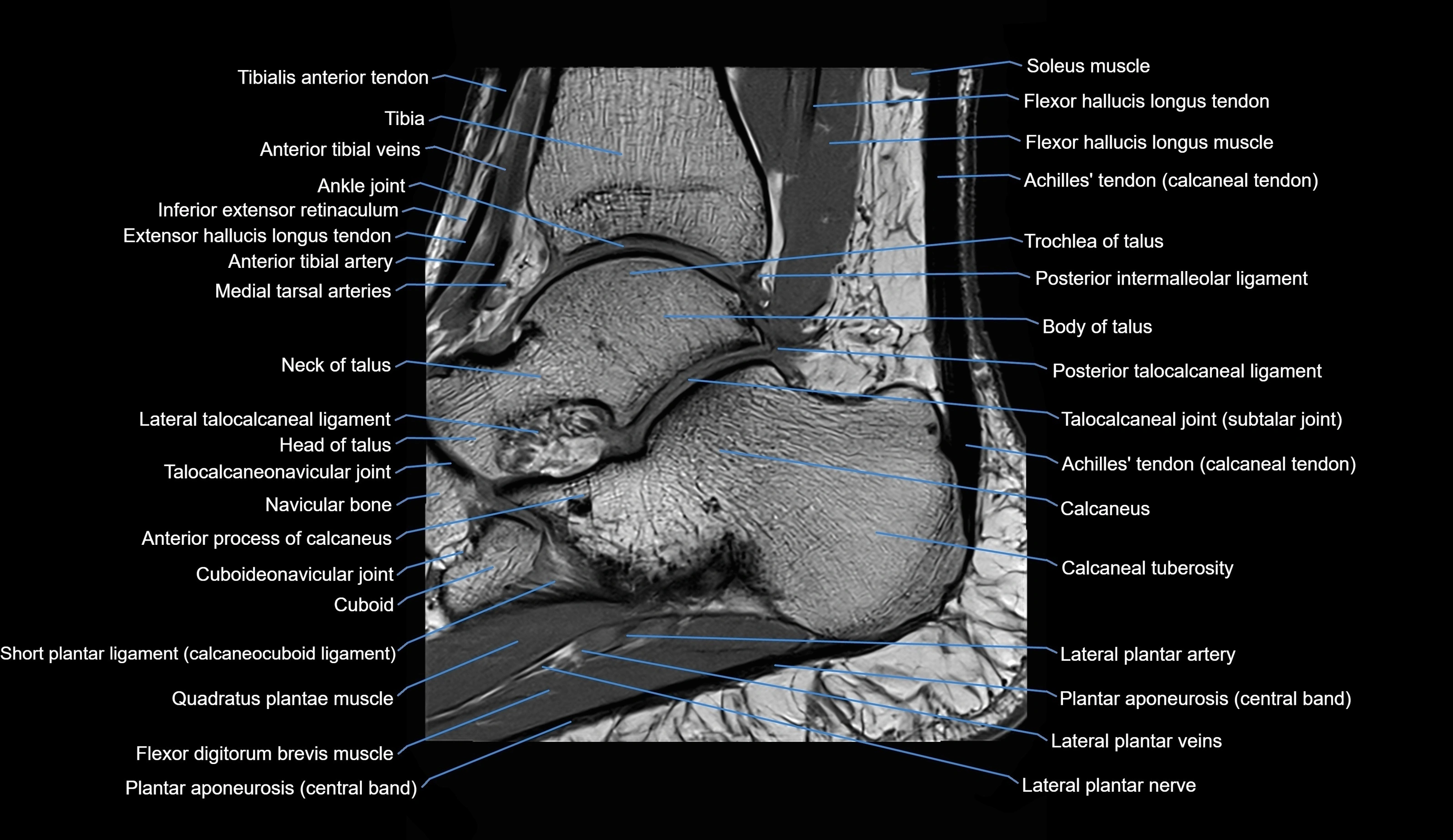 MRI Ankle sagittal cross sectional anatomy 3T  radiology  image-img-00001-00018.webp